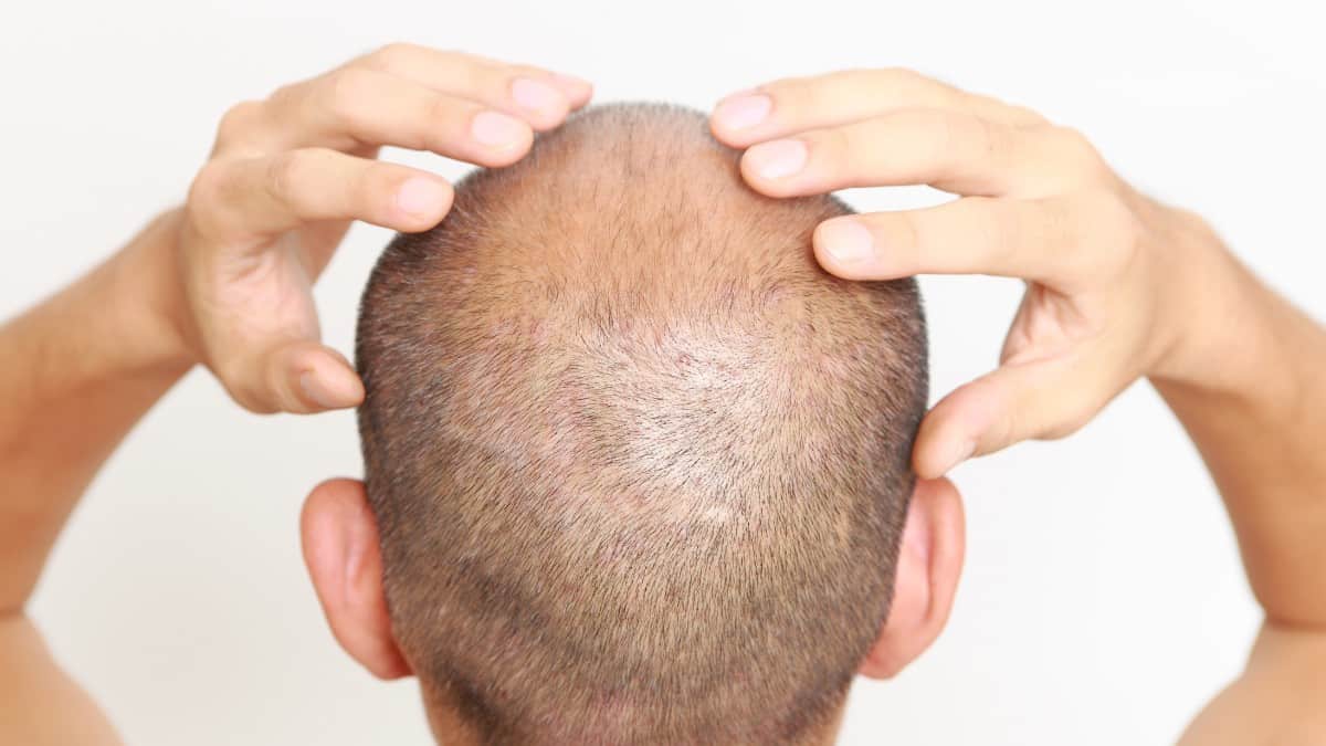 Scalp Micropigmentation