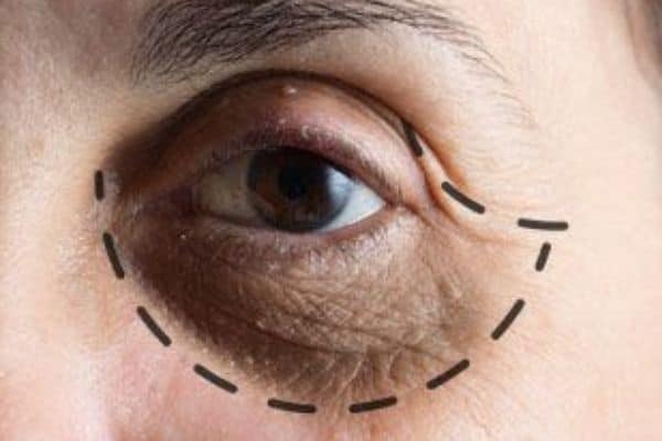under eye bags